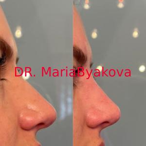Безоперационная коррекция носа (ринопластика)