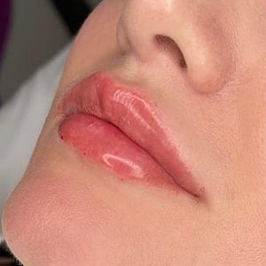 Коррекция губ