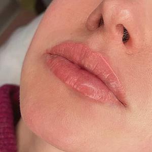 Увеличение губ гиалуроновой кислотой