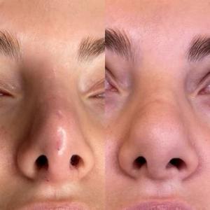 Безоперационная коррекция носа (ринопластика)