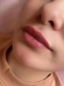 Увеличение губ гиалуроновой кислотой